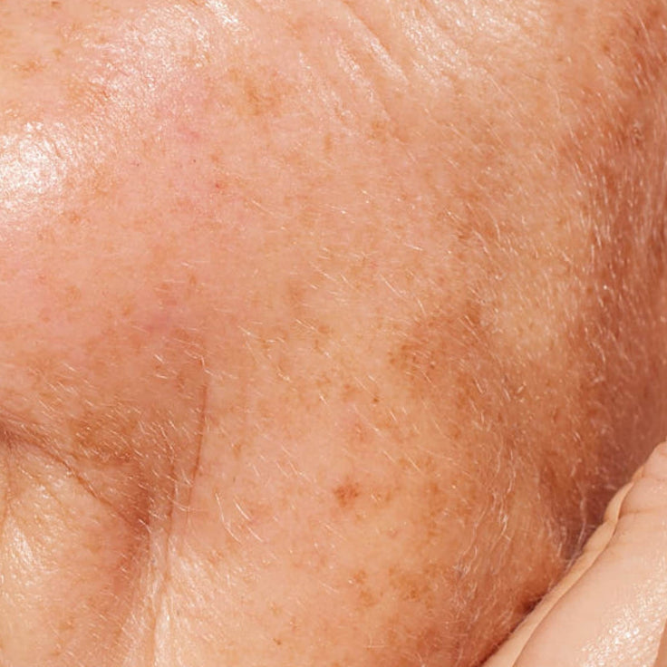 Hyperpigmented skin